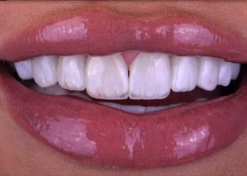 Smile Design 6 Edt Service Smile 35