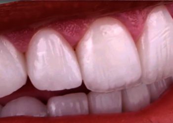 Smile Design 5 Edt Service Smile 37