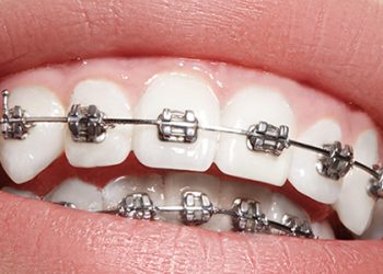 Dental Braces 1 Grd.service Header Braces