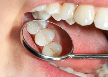 Tooth Bonding 3 Grd.service Tooth Bonding