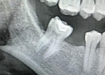 Why Choose Us 3 Wisdom teeth X-ray exam at Elite Dental Touch by Dr. Maria Roman