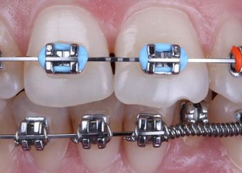 Dental Braces 3 Grd.services Owl Braces.01