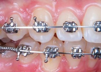 Dental Braces 5 Grd.services Owl Braces.03
